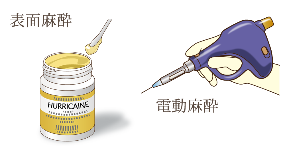 アロハ歯科のむし歯治療