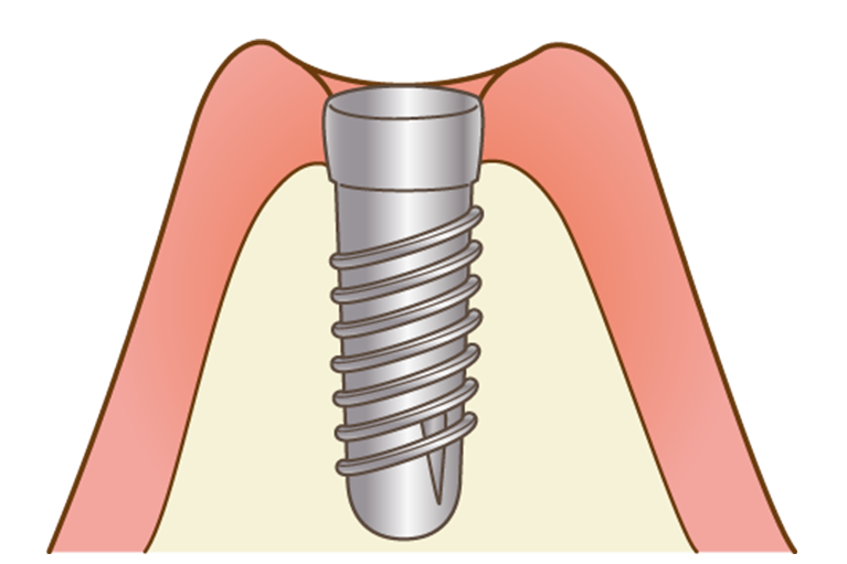 STEP3 インプラント埋入手術（１次オペ）