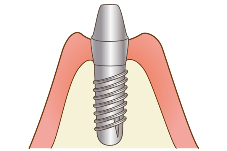 STEP4 インプラント埋入手術（２次オペ）