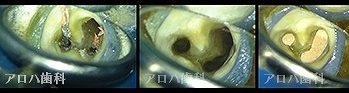 マイクロスコープによる精密な根管治療