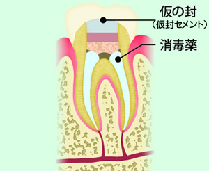 STEP4 消毒薬を詰めて仮封(根管貼薬)