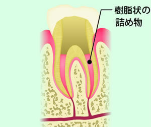 STEP5 根管充填