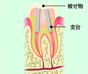 STEP6 土台と被せ